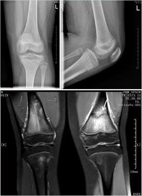 Prevalence and Clinical Significance of Occult Fractures in the Extremities in Children